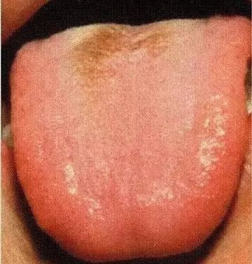 The Most Comprehensive Guide to Tongue Diagnosis! Master It and Become a Tongue Diagnosis Expert