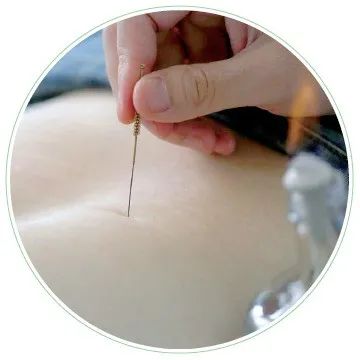 The Historical Development of Fire Needle Therapy