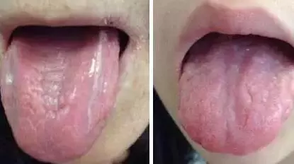 What Does Traditional Chinese Medicine Observe in the Tongue? Nine Body Types and Valuable Tongue Diagnosis Charts!