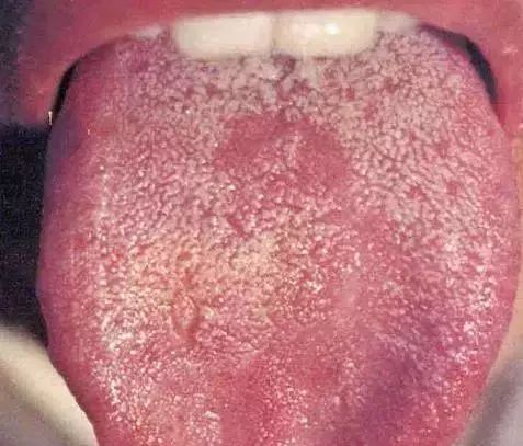 The Most Comprehensive Guide to Tongue Diagnosis! Master It and Become a Tongue Diagnosis Expert