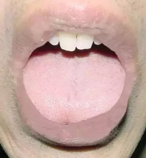 The Most Comprehensive Guide to Tongue Diagnosis! Master It and Become a Tongue Diagnosis Expert