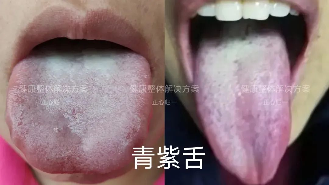 Observing the Tongue for Health: How to Analyze Tongue Quality?