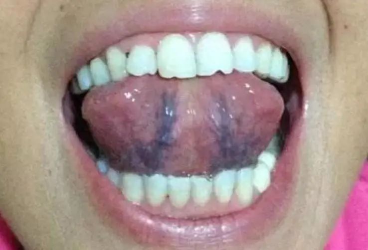 Understanding Blood Stasis: Key Points to Consider for Effective Treatment