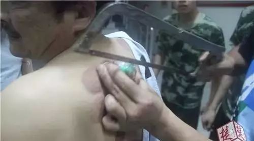 Man Gets Stuck in Cupping Therapy! Firefighters Called for Rescue... Would You Dare to Try It?
