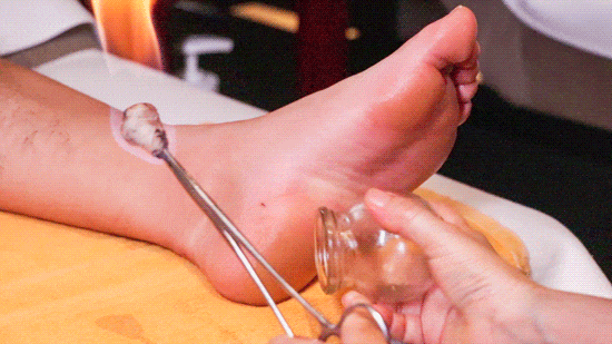 Understanding 'Heat': The Benefits of Cupping Therapy in Summer