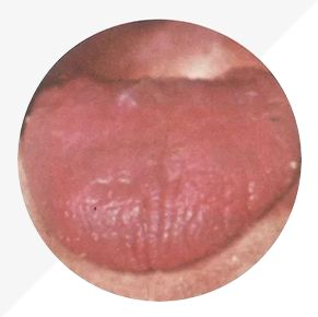 Understanding Tongue Diagnosis in TCM: Insights into Health from Tongue Appearance (Part 2)