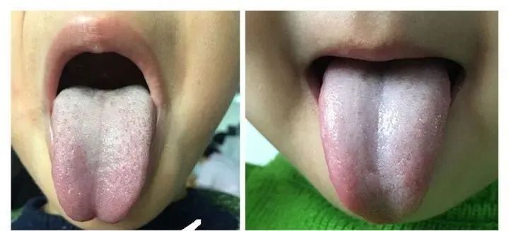 Tongue Coating Diagnosis in Traditional Chinese Medicine