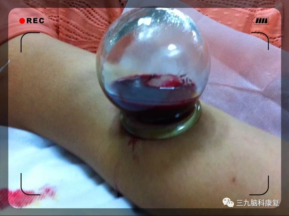 The Wonders of Bloodletting Therapy in Traditional Chinese Medicine