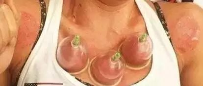 Cupping Therapy: Do You Really Understand It?