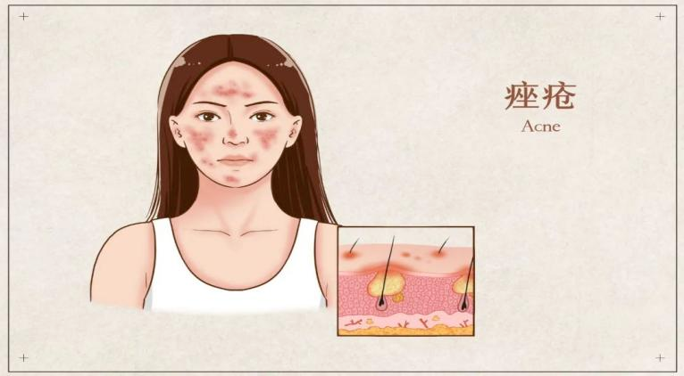 Fire Needle Therapy: A Unique TCM Approach