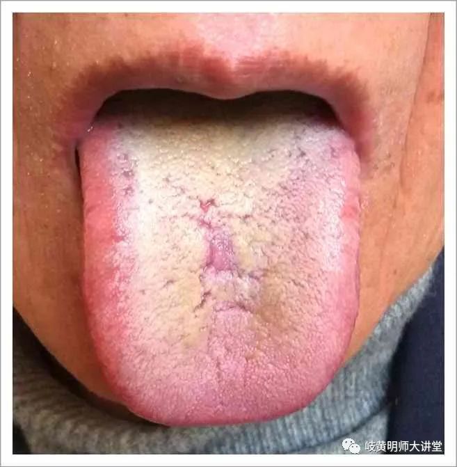 Traditional Chinese Medicine Tongue Diagnosis: Illustrated Guide to 14 Types of Tongue Shapes and Qualities