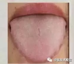 Tongue Diagnosis: Issues Revealed and Simple TCM Remedies