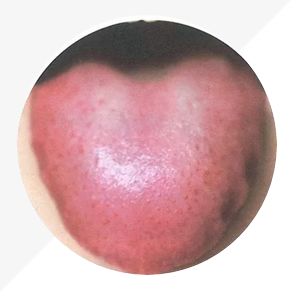 Understanding Tongue Diagnosis in TCM: Insights into Health from Tongue Appearance (Part 2)