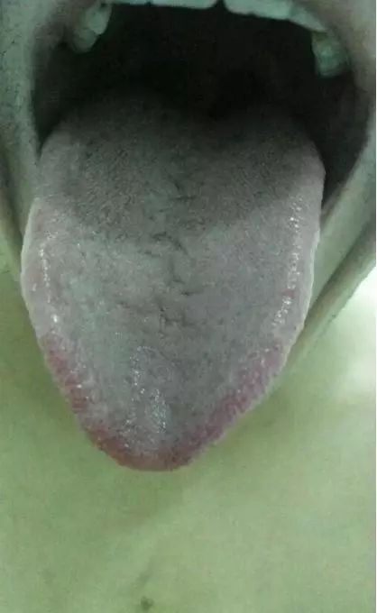 Precious Tongue Diagnosis: Identifying Stomach Yin Deficiency, Severe Yin Fluid Deficiency, Liver Blood Deficiency, and Yang Deficiency with Insufficient Qi and Blood