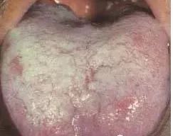Understanding Tongue Diagnosis in Traditional Chinese Medicine (with Tongue Diagnosis Illustrations)
