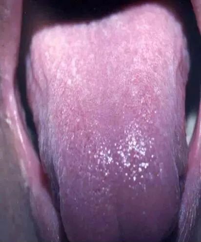 Tongue Diagnosis - Illustrated Guide to Tongue Manifestations