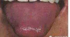 Understanding Tongue Diagnosis in Traditional Chinese Medicine (with Tongue Diagnosis Illustrations)