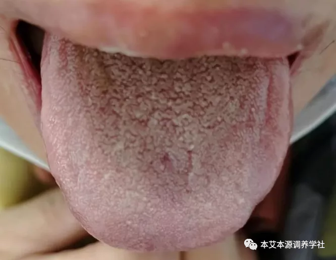 Tongue Diagnosis Series 3: Precise Differentiation of Tongue Coating, Quality, and Shape