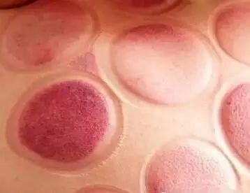 A Comprehensive Guide to Cupping Therapy