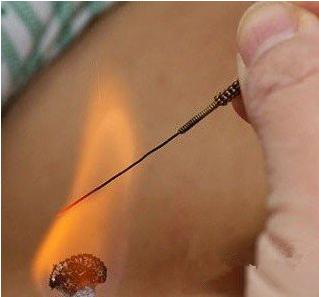 Fire Needle: An Evolution in Acupuncture Therapy