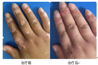 Fire Needle Therapy for Skin Diseases: Visible Safety and Efficacy