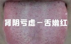 Distinguishing and Treating Kidney Yang Deficiency, Kidney Yin Deficiency, and Kidney Essence Deficiency