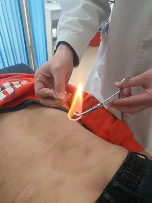 The Remarkable Ancient Essence of TCM: Ten Benefits of Fire Needle Therapy
