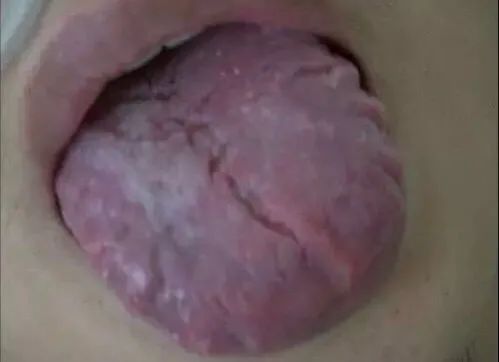 Tongue Diagnosis - Illustrated Guide to Tongue Manifestations