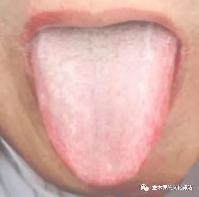 Tongue Diagnosis in Traditional Chinese Medicine: Characteristics of Tongue Coating
