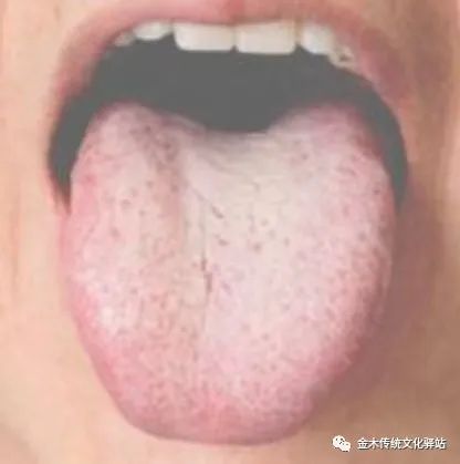 Tongue Diagnosis in Traditional Chinese Medicine: Characteristics of Tongue Coating