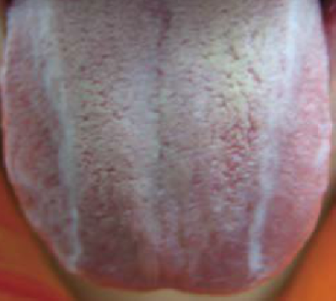 What Does the Tongue of a Phlegm-Damp Constitution Look Like in Traditional Chinese Medicine?