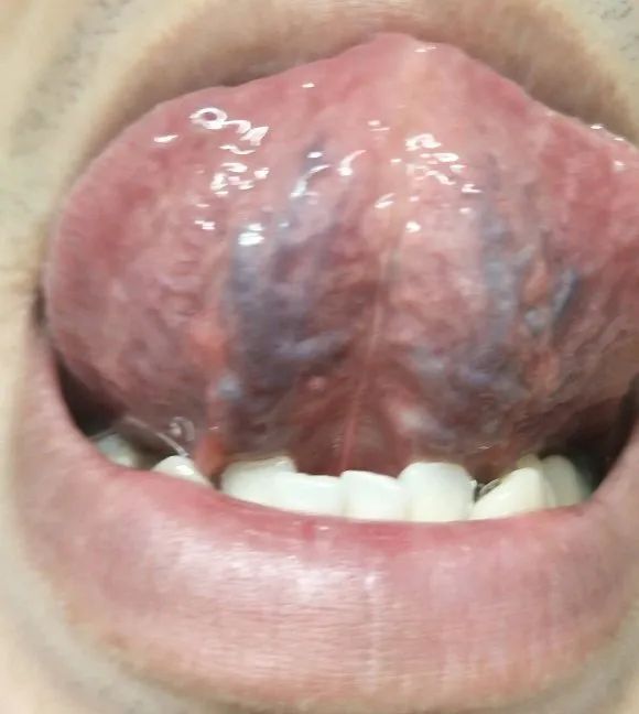 Understanding the Sublingual Collaterals in Traditional Chinese Medicine