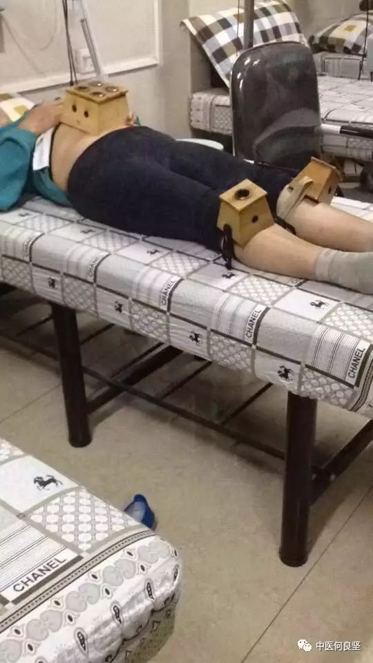 Cupping Therapy for Obesity