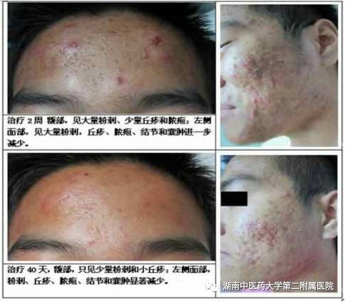 Unique Techniques of Fire Needle Therapy for Skin Diseases