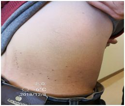 Understanding Fire Needle Therapy in Traditional Chinese Medicine