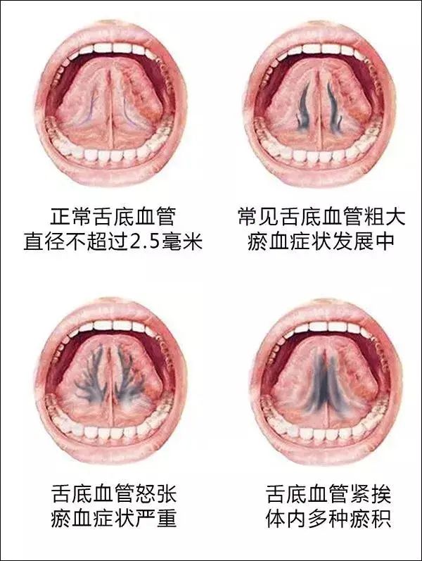 Sublingual Bloodletting to Alleviate Heart Meridian Stagnation