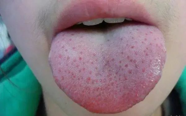 Tongue Coating Diagnosis in Traditional Chinese Medicine