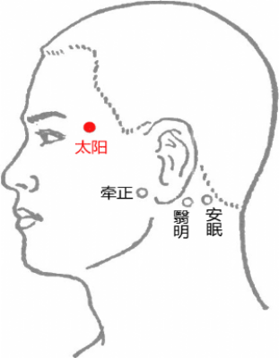 Traditional Chinese Medicine Treatment for Wind-Cold Headache