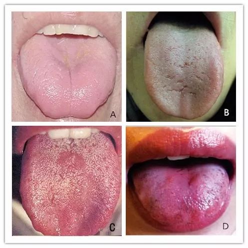 Five Key Points of Tongue Diagnosis in Traditional Chinese Medicine