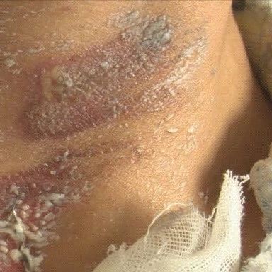 Cupping Tragedy Reoccurs! A Woman in Xuzhou Suffers Burns from Cupping; Essential Precautions You Must Know