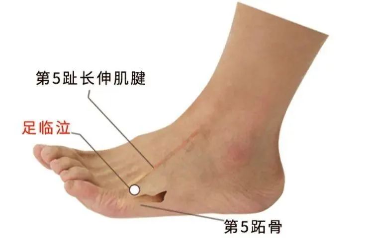 Traditional Fine Needle Technique for Acupuncture Treatment of Sciatica