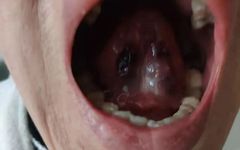 Sublingual Bloodletting to Alleviate Heart Meridian Stagnation