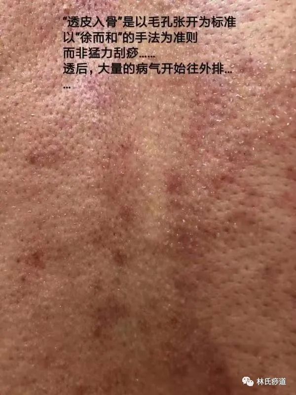 Key Points of Gua Sha