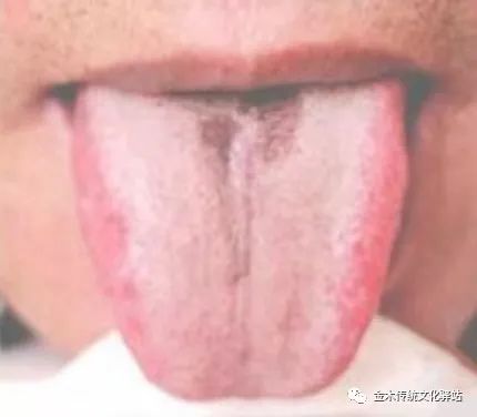 Tongue Diagnosis in Traditional Chinese Medicine: Tongue Coating