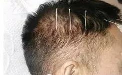 The Miraculous "Three Needles" in TCM Acupuncture: Treating One Disease with Three Acupuncture Points
