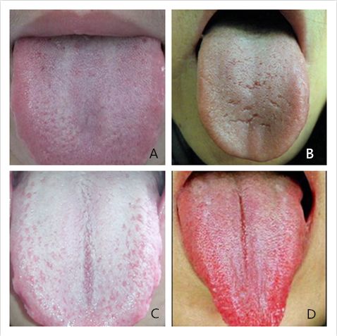 Five Key Points of Tongue Diagnosis in Traditional Chinese Medicine