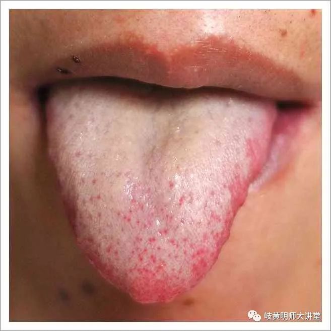 Traditional Chinese Medicine Tongue Diagnosis: Illustrated Guide to 14 Types of Tongue Shapes and Qualities
