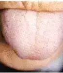 Comprehensive Guide to Tongue Diagnosis: Learn How Your Tongue Reflects Your Health!
