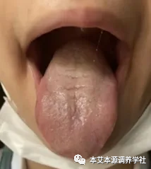 Tongue Diagnosis Series 3: Precise Differentiation of Tongue Coating, Quality, and Shape