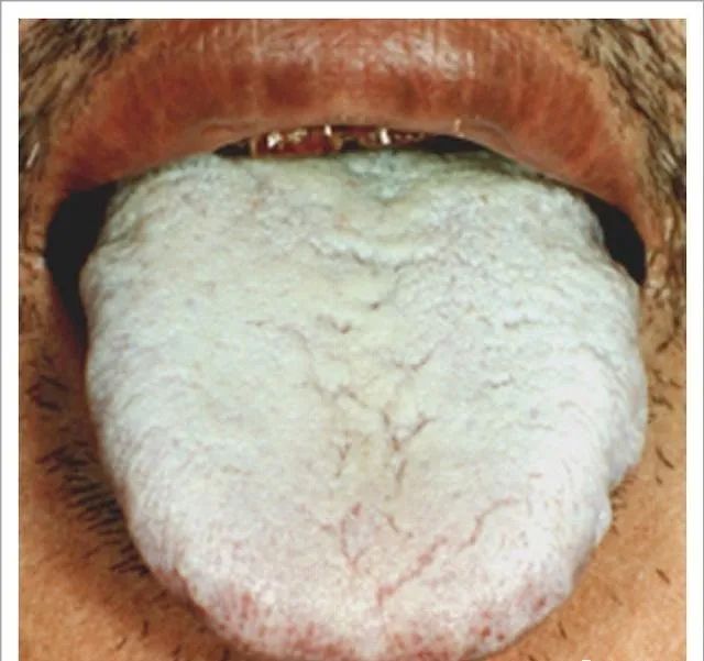 Traditional Chinese Medicine Tongue Diagnosis: 26 Clinical High-Definition Tongue Diagnosis Images with Analysis
